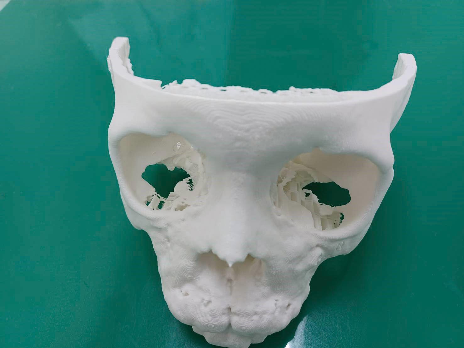 電腦斷層重組的3D模型可發現左側上顎犬齒位於左側眼眶中